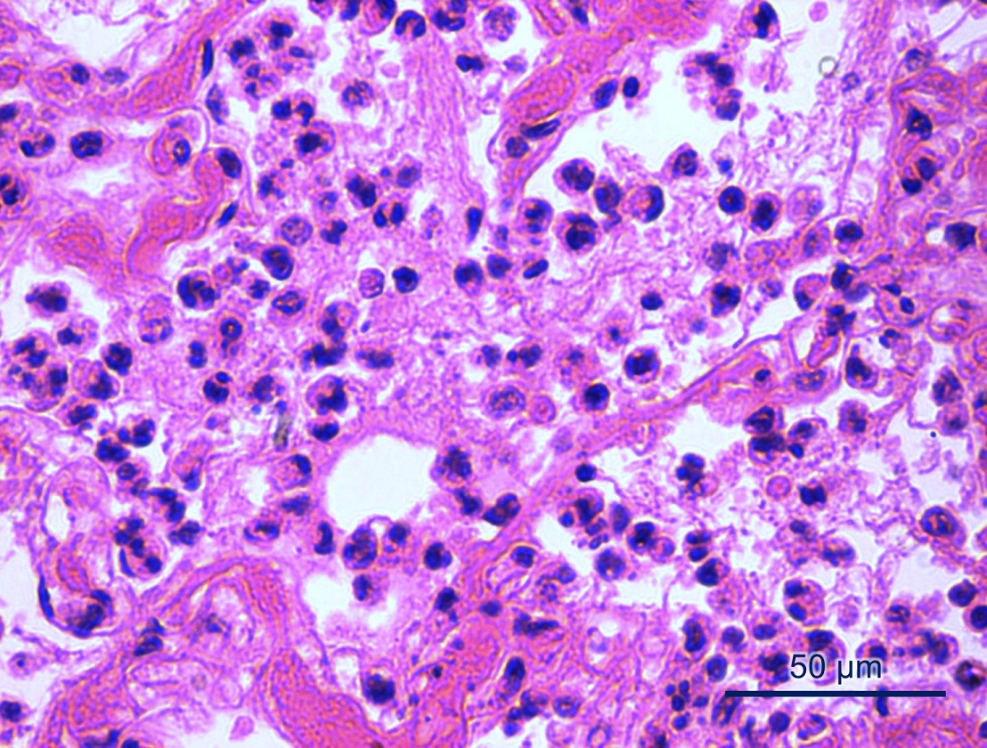 Bronconeumonía    intersticial con predominio de neutrófilos y eosinófilos y en menor    proporción macrófagos y linfocitos. HE. Barra = 50 μm